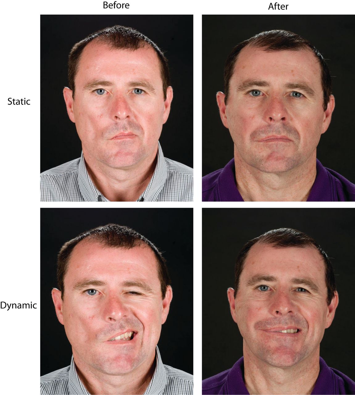 Drooping Face: How to Treat Bell's Palsy with Physiotherapy - pt